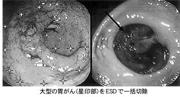 大型の胃がん（星印部）をESDで一括切除